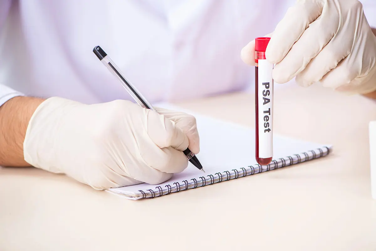 prostata specifični antigen